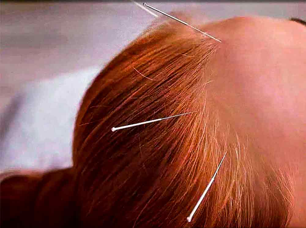 crânio acupuntura