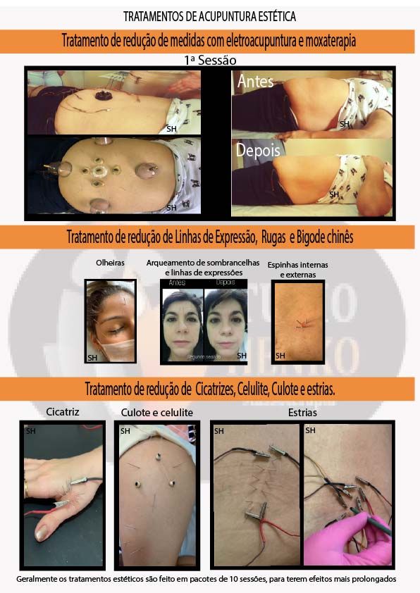 tratamentos de acupuntura estética